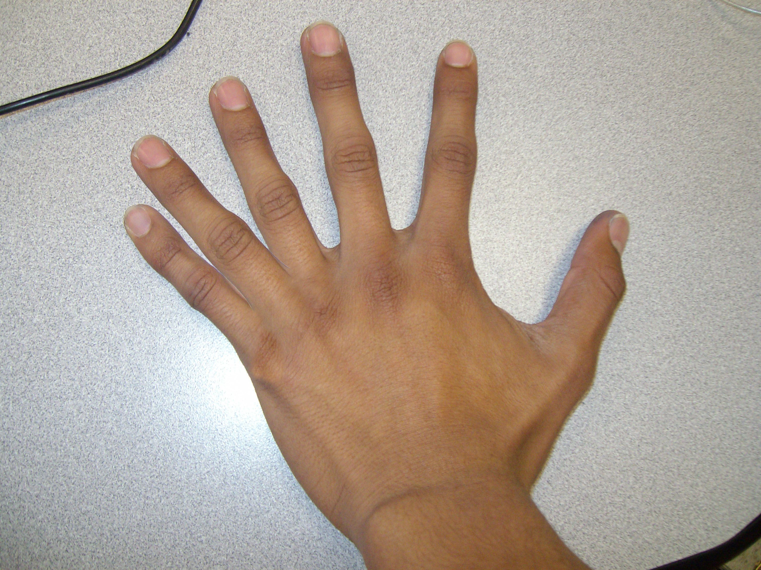 Рука с 6 пальцами фото
